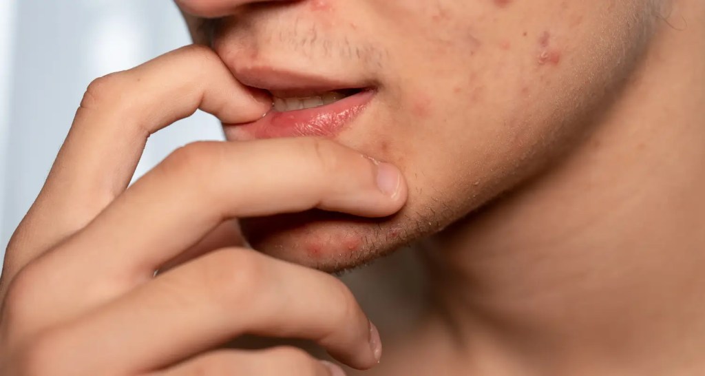 Wajah Kusam dan Bruntusan Bikin Nggak Pede? Ini Solusinya!